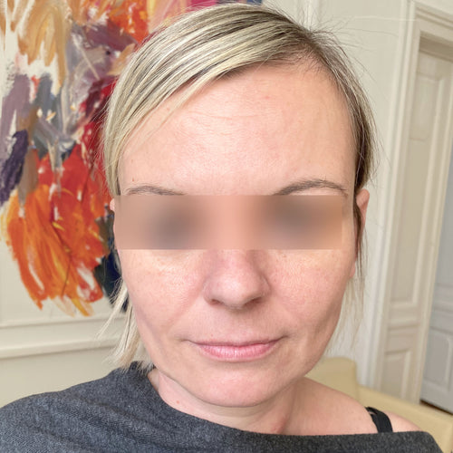 After Hydrocollagen 2-Month Treatment