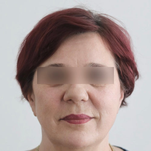 After Hydrocollagen 3 Month-Treatment