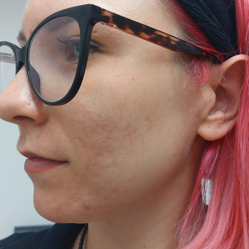 After Hydrocollagen 3 Month-Treatment