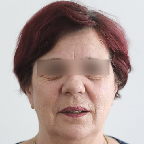 Before Hydrocollagen 3 Month-Treatment