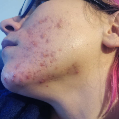 Before Hydrocollagen 3 Month-Treatment